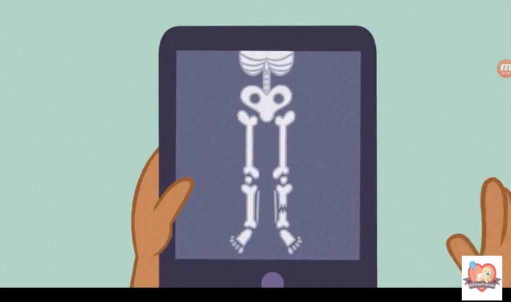 Learn about Skeletal System for Kids - broken tibia 3